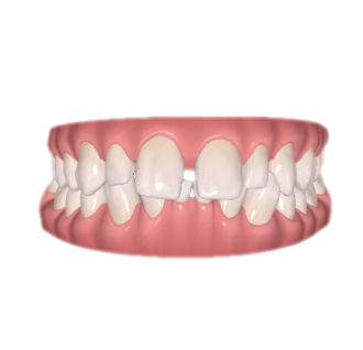 tandreglering treatment example1