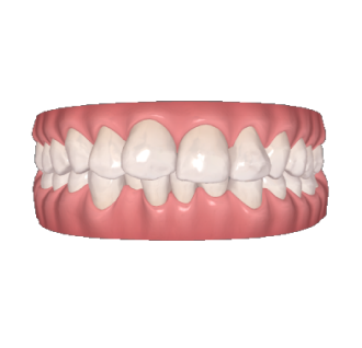 Tandreglering treatment example1